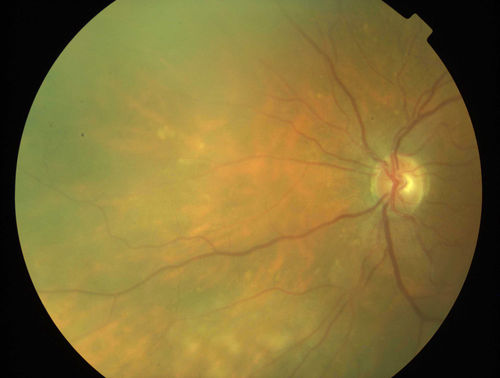 Primary Ocular Lymphoma - 051812 
