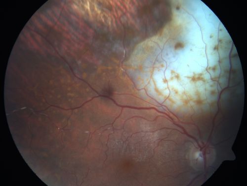 Primary Ocular Lymphoma - White Mass Left Eye - 112712 
