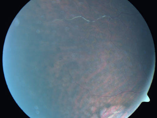 Primary Ocular Lymphoma - White Mass Left Eye - 112712 
