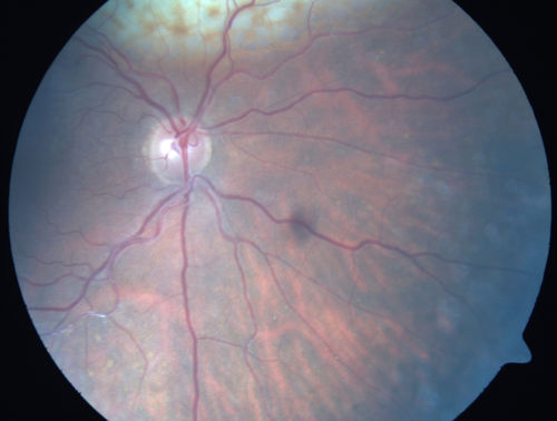 Primary Ocular Lymphoma - White Mass Left Eye - 112712 
