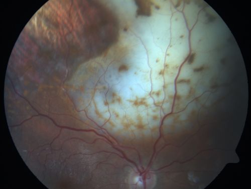 Primary Ocular Lymphoma - White Mass Left Eye - 112712 
