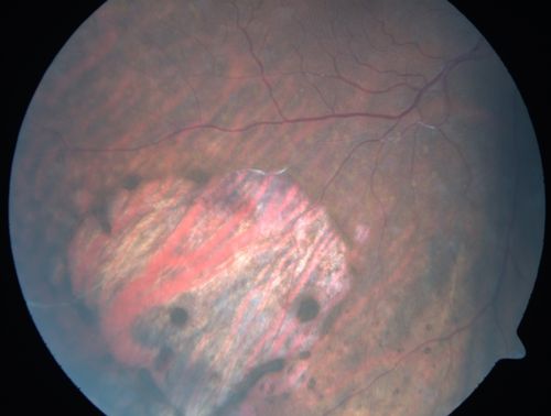 Primary Ocular Lymphoma - White Mass Left Eye - 112712 
