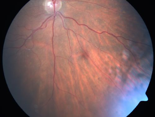 Primary Ocular Lymphoma - White Mass Left Eye - 112712 
