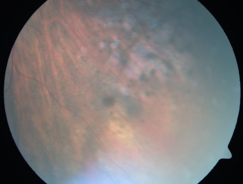 Primary Ocular Lymphoma - White Mass Left Eye - 112712 

