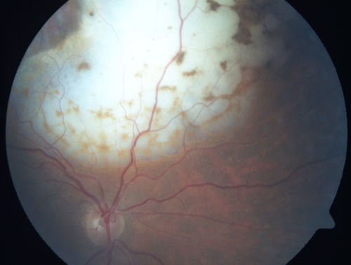Primary Ocular Lymphoma - White Mass Left Eye - 112712 
