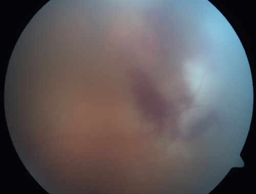 Primary Ocular Lymphoma - White Mass Left Eye - 112712 
