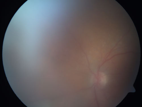 Primary Ocular Lymphoma - White Mass Left Eye - 112712 
