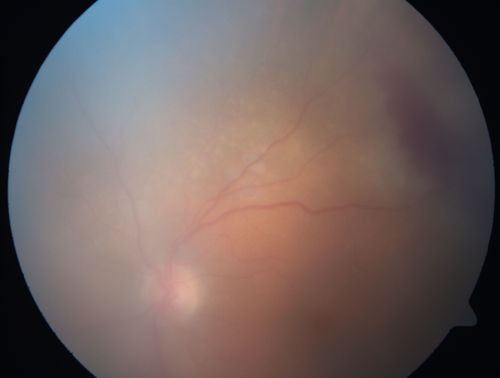 Primary Ocular Lymphoma - White Mass Left Eye - 112712 

