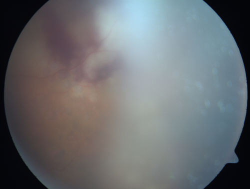 Primary Ocular Lymphoma - White Mass Left Eye - 112712 

