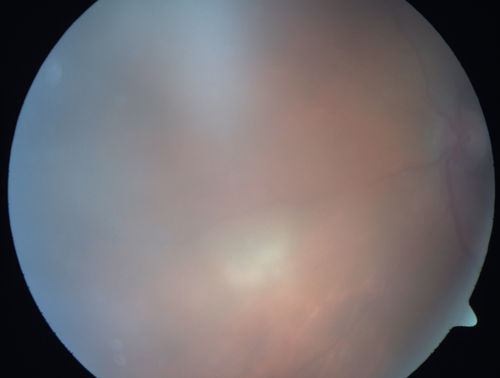Primary Ocular Lymphoma - White Mass Left Eye - 112712 
