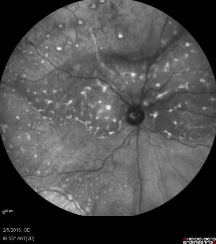 Primary Ocular Lymphoma - 020513 
