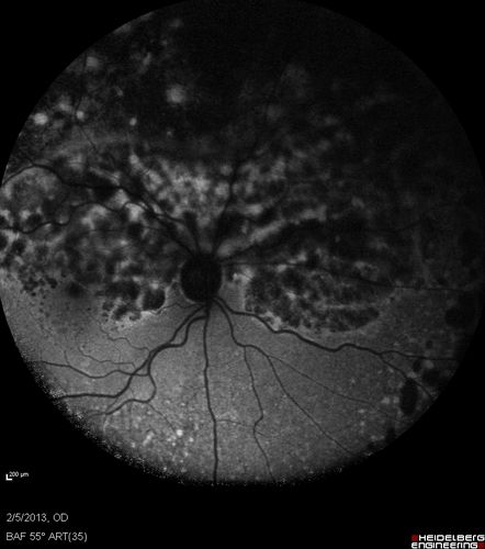 Primary Ocular Lymphoma - 020513  - FUndus Autofluorescence
