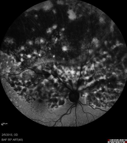 Primary Ocular Lymphoma - 020513  - FUndus Autofluorescence
