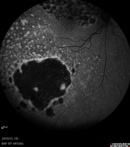 Primary Ocular Lymphoma - 020513  - FUndus Autofluorescence

