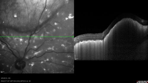 Primary Ocular Lymphoma - 020513  - SD OCT
