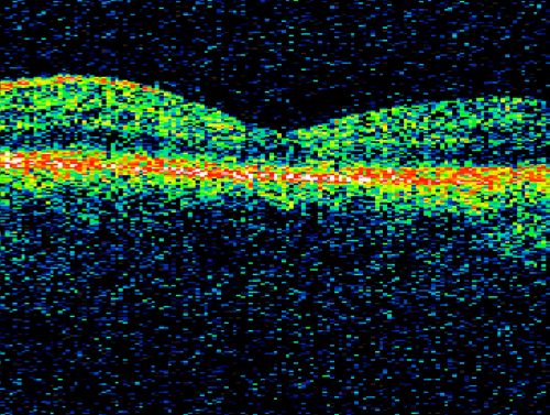 Chronic Central Serous Retinopathy treated with Photodynamic Laser and Visudyne
48-year-old man has had waxing and waning vision in the left eye for the last year from central serous retinopathy. OD is 20/16, OS is 20/16 - 2 months post PDT therapy with Visudyne.
