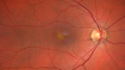 Pattern Dystrophy with Collapsed Vitelliform
74 year old female with vision loss in eye with collapsed vitelliform lesion.
