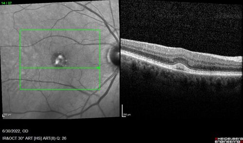 Pattern Dystrophy with Collapsed Vitelliform
74 year old female with vision loss in eye with collapsed vitelliform lesion.
