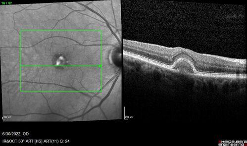 Pattern Dystrophy with Collapsed Vitelliform
74 year old female with vision loss in eye with collapsed vitelliform lesion.
