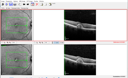 Pattern Dystrophy with Collapsed Vitelliform
74 year old female with vision loss in eye with collapsed vitelliform lesion.
