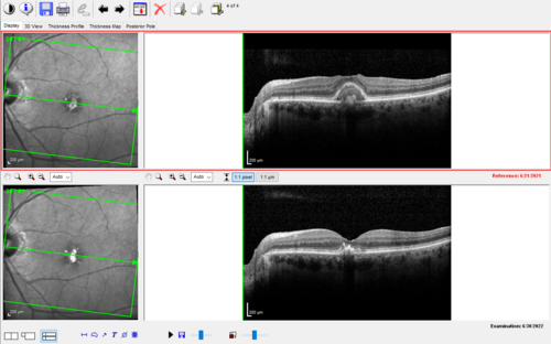 Pattern Dystrophy with Collapsed Vitelliform
74 year old female with vision loss in eye with collapsed vitelliform lesion.
