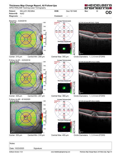 Pattern Dystrophy with Collapsed Vitelliform
74 year old female with vision loss in eye with collapsed vitelliform lesion.
