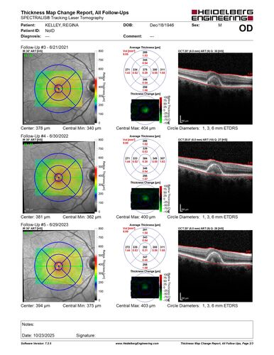 Pattern Dystrophy with Collapsed Vitelliform
74 year old female with vision loss in eye with collapsed vitelliform lesion.
