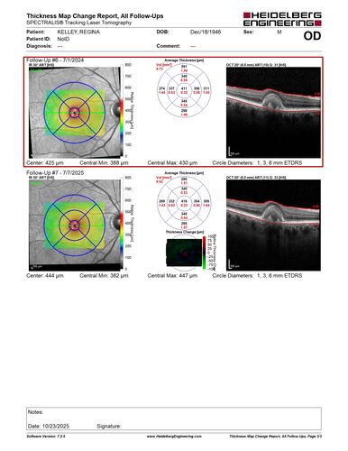 Pattern Dystrophy with Collapsed Vitelliform
74 year old female with vision loss in eye with collapsed vitelliform lesion.
