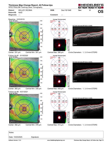 Pattern Dystrophy with Collapsed Vitelliform
74 year old female with vision loss in eye with collapsed vitelliform lesion.
