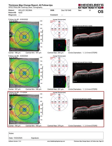 Pattern Dystrophy with Collapsed Vitelliform
74 year old female with vision loss in eye with collapsed vitelliform lesion.
