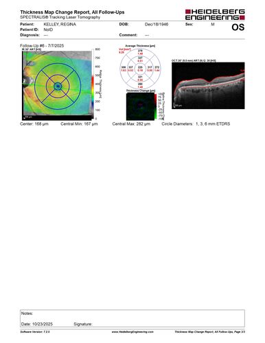 Pattern Dystrophy with Collapsed Vitelliform
74 year old female with vision loss in eye with collapsed vitelliform lesion.
