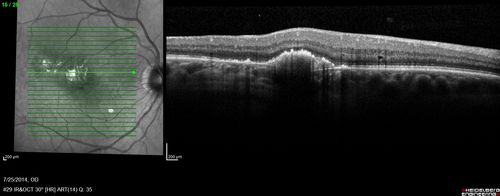 Photic Maculopathy Following Cataract Surgery
Initial images are from 1 week and subsequent images from 1 month post surgery.

