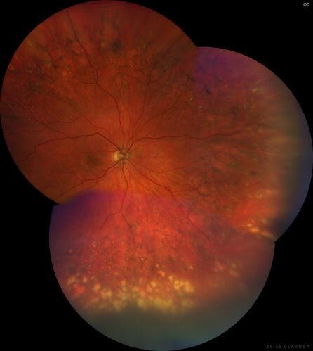 Peripheral reticular pigment degeneration - pavingstone degeneration - age-related macular degeneration
60 year old healthy man with intermediate AMD and peripheral pigment degeneration and pavinstone degeneration.  Vision is 20/20 OU and the patient is asymptomatic.  No significant history of AMD and he is a non-smoker.
