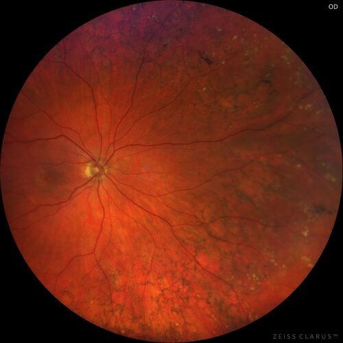 Peripheral reticular pigment degeneration - pavingstone degeneration - age-related macular degeneration
60 year old healthy man with intermediate AMD and peripheral pigment degeneration and pavinstone degeneration.  Vision is 20/20 OU and the patient is asymptomatic.  No significant history of AMD and he is a non-smoker.
