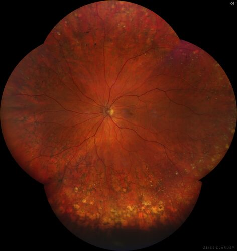 Peripheral reticular pigment degeneration - pavingstone degeneration - age-related macular degeneration
60 year old healthy man with intermediate AMD and peripheral pigment degeneration and pavinstone degeneration.  Vision is 20/20 OU and the patient is asymptomatic.  No significant history of AMD and he is a non-smoker.
