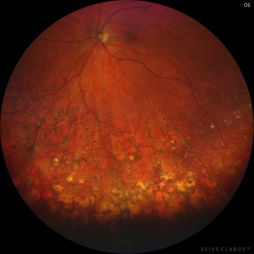 Peripheral reticular pigment degeneration - pavingstone degeneration - age-related macular degeneration
60 year old healthy man with intermediate AMD and peripheral pigment degeneration and pavinstone degeneration.  Vision is 20/20 OU and the patient is asymptomatic.  No significant history of AMD and he is a non-smoker.
