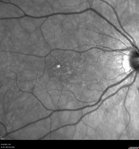 Peripheral reticular pigment degeneration - pavingstone degeneration - age-related macular degeneration
60 year old healthy man with intermediate AMD and peripheral pigment degeneration and pavinstone degeneration.  Vision is 20/20 OU and the patient is asymptomatic.  No significant history of AMD and he is a non-smoker.
