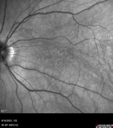 Peripheral reticular pigment degeneration - pavingstone degeneration - age-related macular degeneration
60 year old healthy man with intermediate AMD and peripheral pigment degeneration and pavinstone degeneration.  Vision is 20/20 OU and the patient is asymptomatic.  No significant history of AMD and he is a non-smoker.
