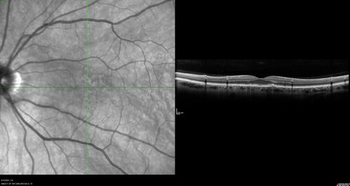 Peripheral reticular pigment degeneration - pavingstone degeneration - age-related macular degeneration
60 year old healthy man with intermediate AMD and peripheral pigment degeneration and pavinstone degeneration.  Vision is 20/20 OU and the patient is asymptomatic.  No significant history of AMD and he is a non-smoker.
