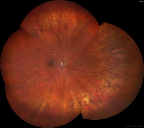 Peripheral Reticular Pigment Degeneration
81  year old man with a choroidal nevus in the right eye.  VA 20/20 OU.  There is extensive peripheral pigment degeneration
