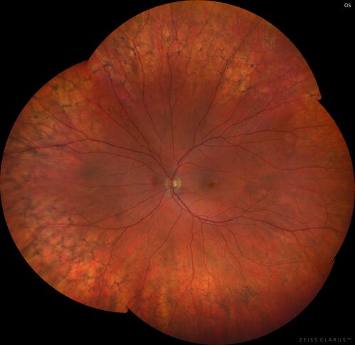 Peripheral Reticular Pigment Degeneration
81  year old man with a choroidal nevus in the right eye.  VA 20/20 OU.  There is extensive peripheral pigment degeneration
