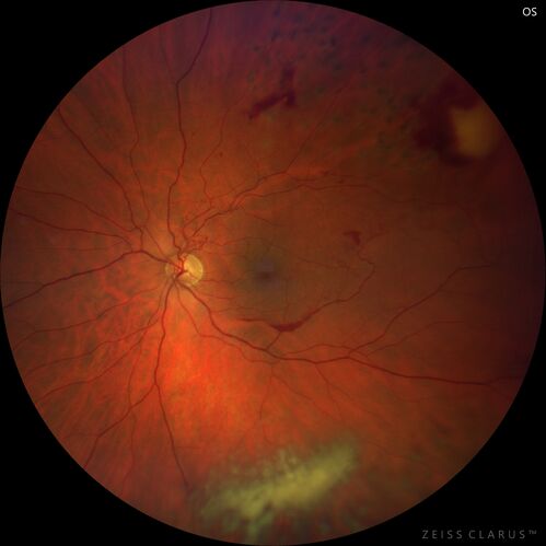 Branch Retinal Vein Occlusion with Neovascularization Elsewhere and Vitreous Hemorrhage - 1 month post laser
57 year old man New floaters in the left eye about a month ago.  Now they are getting better.  PMHx A-Fib on Pradaxa
VA 20/32 OD, 20/40 OS
1+ NS OU
BP 137/77, 200LBs, 5â€™8â€

PRP laser was done
