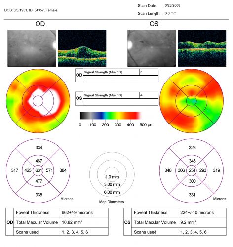 Diabetic and Pseudophakic Cystoid Macular Edema Pre Treatment
56-year-old woman has diabetic retinopathy in both eyes and macular edema.  She is recently pseudophakic.  OD 20/80, OS 20/200.  
Keywords: cme;bdr;pseudophakic;laser;kenalog