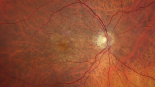 Wet AMD - Type 1 CNVM - RAP lesion
92 year old man with vision loss and very high PED.  Because of worry about a PED tear, patient was treated with avastin, then lucentis, then eyelea, then vabysmo (progressively stronger meds)
