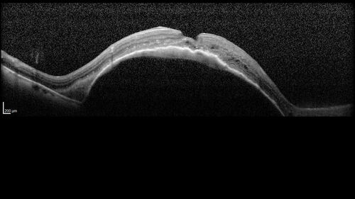 Wet AMD - Type 1 CNVM - RAP lesion
92 year old man with vision loss and very high PED.  Because of worry about a PED tear, patient was treated with avastin, then lucentis, then eyelea, then vabysmo (progressively stronger meds)
