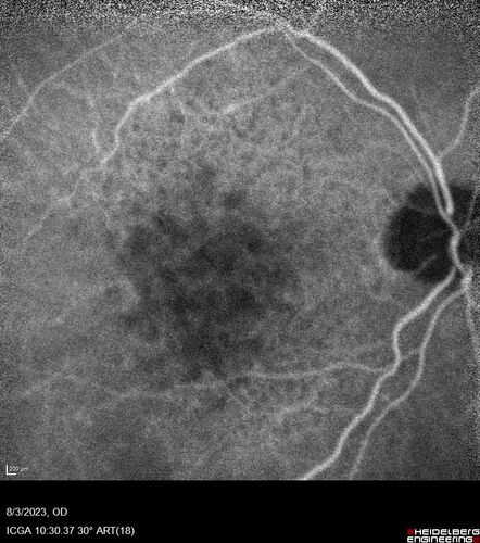 Wet AMD - Type 1 CNVM - RAP lesion
92 year old man with vision loss and very high PED.  Because of worry about a PED tear, patient was treated with avastin, then lucentis, then eyelea, then vabysmo (progressively stronger meds)
