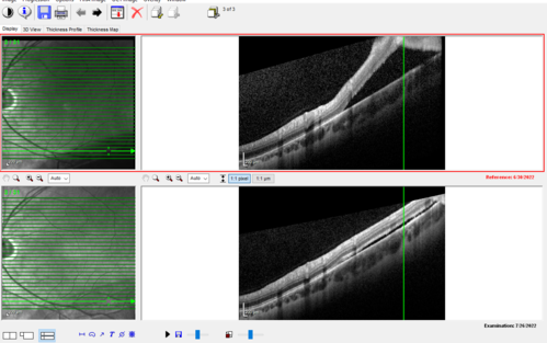 Asymptomatic progressing retinal detachment 27 year old man
This detachment was followed for one month, progressed, and was repaired with a scleral buckle.
