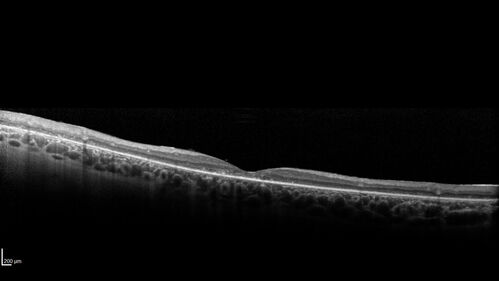 Retinitis Pigmentosa - Autosomal Dominant - Rho Mutation
55 year old female 55 year old female Vision loss since age 25. It runs in the family big time.Â  Paternal grandmother and one of her sisters, father had it, all three of his children had it and her biological nephew have RP.  VA 20/80 OD, 20/125 OS
