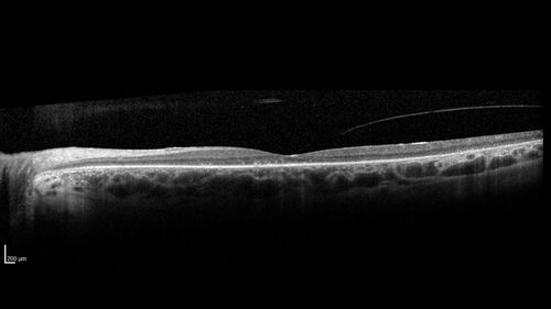 Retinitis Pigmentosa - Autosomal Dominant - Rho Mutation
55 year old female 55 year old female Vision loss since age 25. It runs in the family big time.Â  Paternal grandmother and one of her sisters, father had it, all three of his children had it and her biological nephew have RP.  VA 20/80 OD, 20/125 OS
