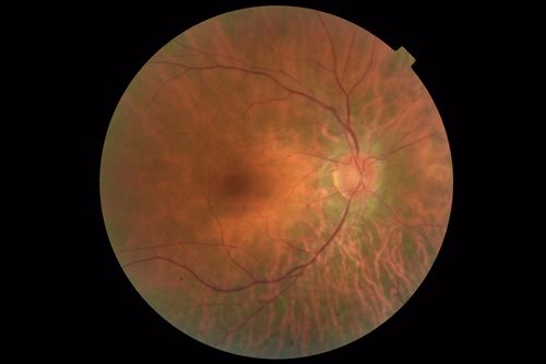 Retinitis Pigmentosa with Cystoid Macular Edema responsive to topical carbonic anhydrase inhibitors
67 year old female  She thought it was time to have her glasses changed.She has no family history of reitnal disease and has never been diagnosed with a problem.   She started having night vision trouble the last year.  Two sisters and a brother with normal vision.  
VA OD: Dcc20/40-2 NccJ3
VA OS: Dcc20/20 NccJ1
IOP: TP: OD:9
